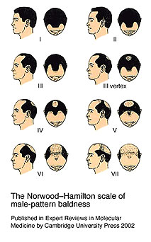 norwood baldness scale