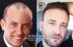 Koher Hair Transplants Jernigans Raleigh NC