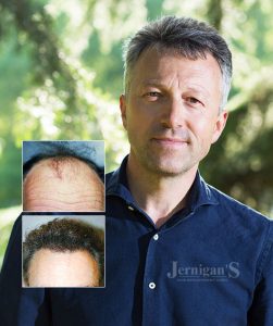 hair transplant restoration replacement raleigh north carolina