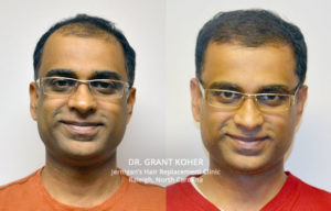 hair loss restoration transplant raleigh nc