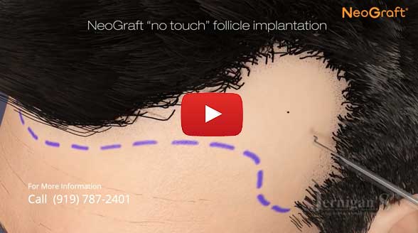 NeoGraft FUE Hair Transplants