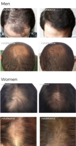 fda cleared hair loss treatment androgenetic alopecia