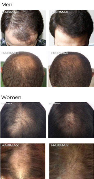 fda cleared hair loss treatment androgenetic alopecia raleigh nc
