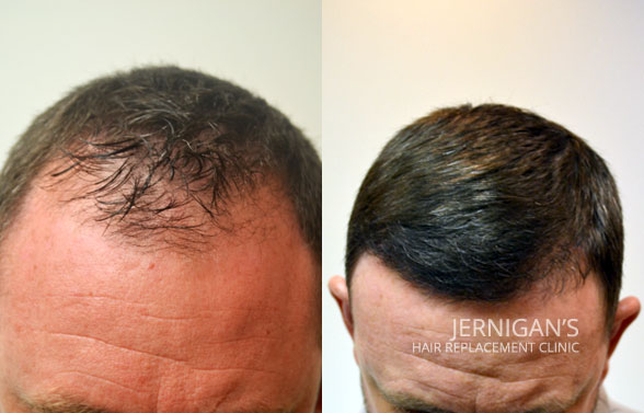 Mens hair loss replacement restoration Raleigh NC