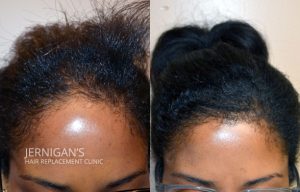 womens hair transplant restoration raleigh nc