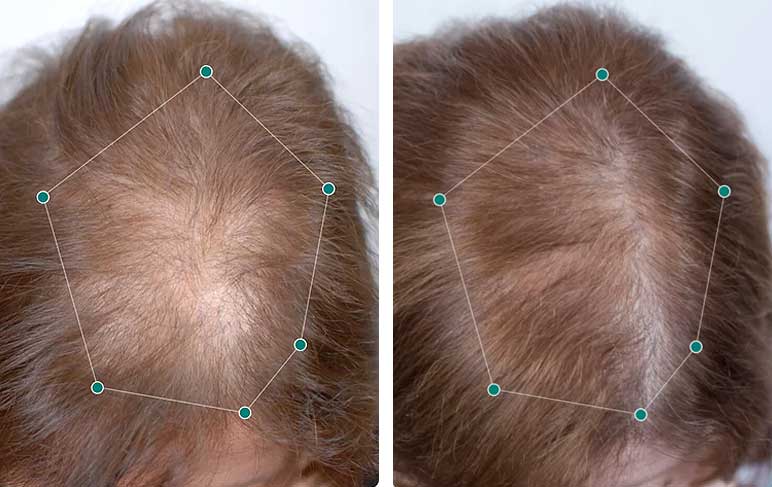 nutrifol women hair regrowth before after