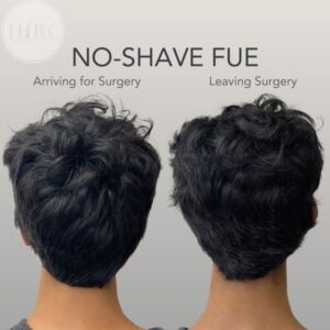 no shave FUE shaveless hair transplant raleigh nc