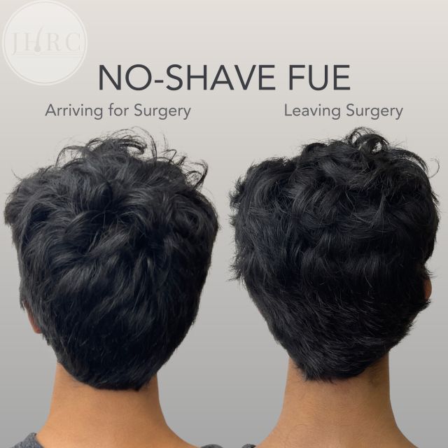 No Shave FUE Shaveless Hair Transplant Raleigh NC